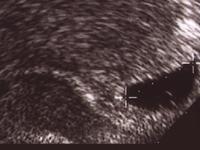 Fruchtsack in der 6.Schwangerschaftswoche im Ultraschall